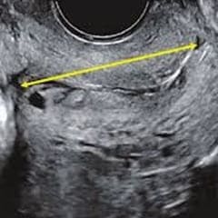 Insuficiencia cervical