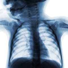 Inductores de madurez pulmonar