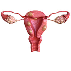 Miomatosis uterina